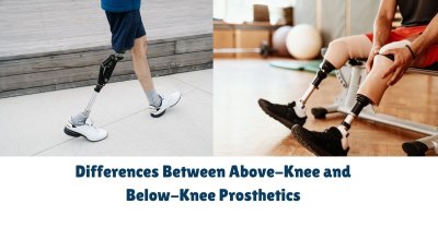 Differences Between Above-Knee and Below-Knee Prosthetics